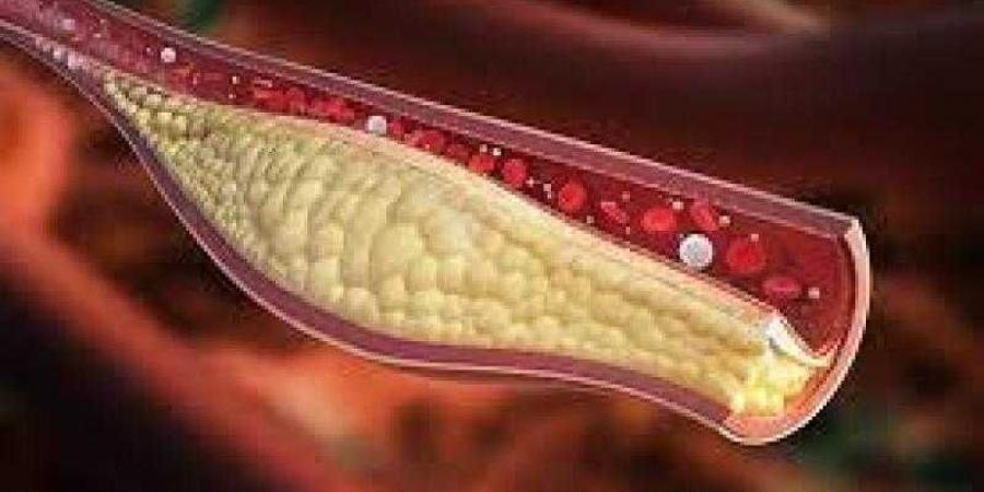 معلومات مهمة لمرضى الكوليسترول الضار بالدم - نبض مصر