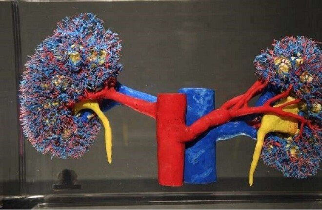 أطعمة تزيد خطر حصى الكلى.. وخبراء يوضحون النظام الغذائي الوقائي