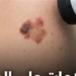 “إشارات علي جلدك ممكن تنقذ حياتك.. تجاهلها ممكن يكلفك كتير