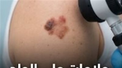 “إشارات علي جلدك ممكن تنقذ حياتك.. تجاهلها ممكن يكلفك كتير