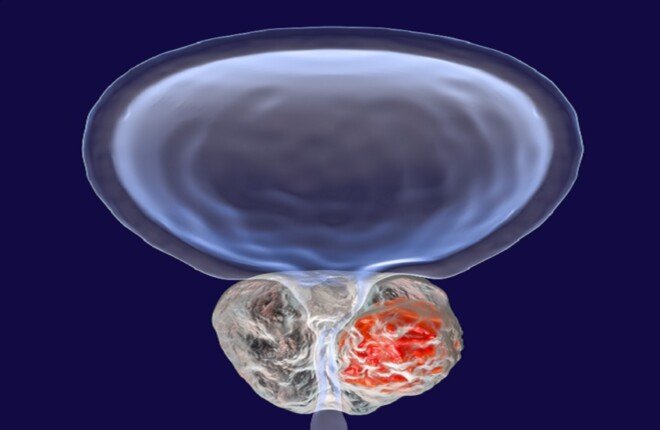 اكتشاف علمي جديد يوضح دور جزيئات الحمض النووي الريبوزي في تطور سرطان البروستاتا