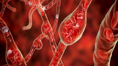 تحذيرات علمية دولية.. عامل بيئي خفي وراء ارتفاع ضغط الدم