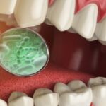 علكة حيوية تقضي على ميكروبات الفم المرتبطة بسرطان الرأس والرقبة